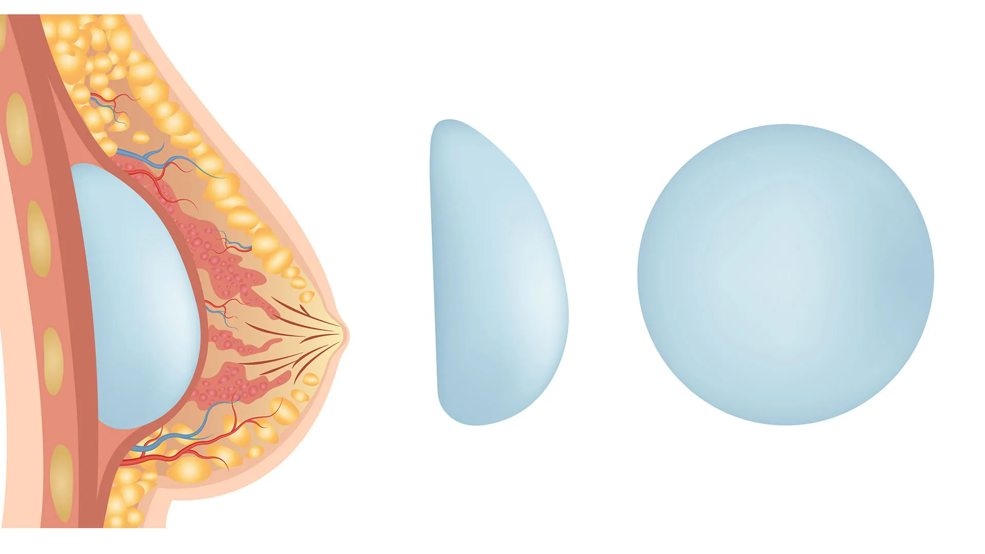 implantes mamarios con forma redonda