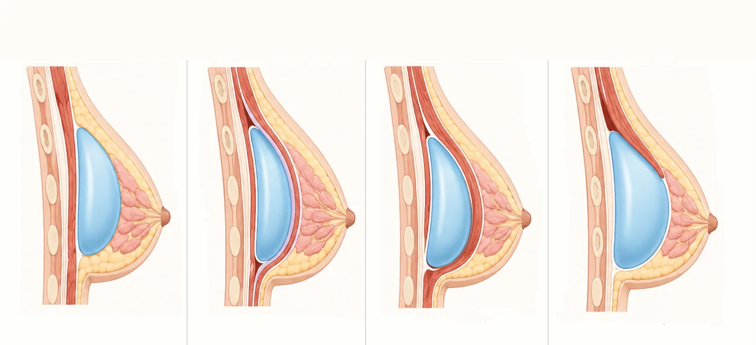 ¿Dónde se colocan los implantes mamarios en una mamoplastia?