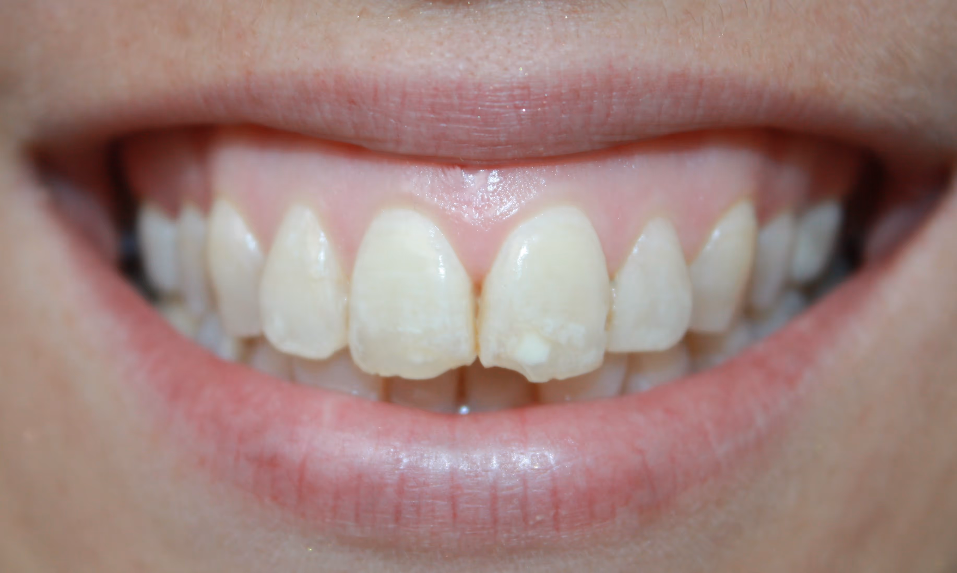 before and after treatment