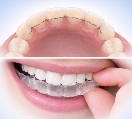 Stabilisierung des Behandlungsresultats