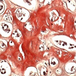 coupe histologique de rein en coloration rouge congo dans une amylose AL