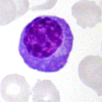 image de plasmocyte malin