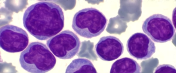 Lymphoplasmocytes