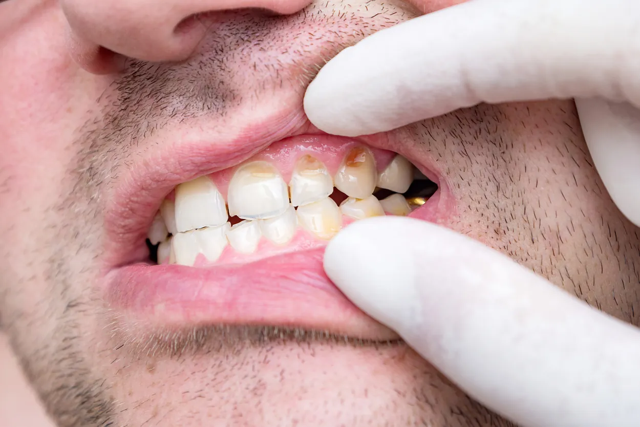 Close-up dental exam under bright clinical lighting showing a patient's mouth, with gloved fingers pulling back lips to reveal worn, stained teeth.