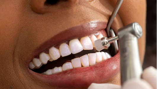 Close-up of professional dental polishing treatment with a soft bristle brush under bright clinical lighting. Mirror reflecting clean, white teeth.