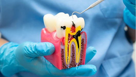 Dentist in blue scrubs and gloves demonstrating tooth decay and root canal structure using a colorful dental cross-section model under bright light.