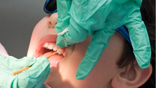Dentist in teal gloves applying fluoride treatment to a child's teeth under bright clinical lighting.