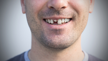 A man smiling with a broken missing tooth