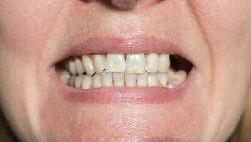 A smile with worn down grinded teeth