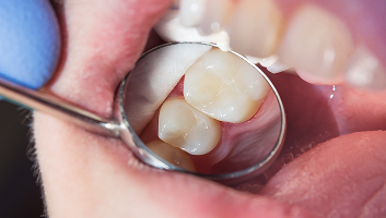 A reflector showing teeth