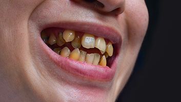A smile with crooked discolored teeth