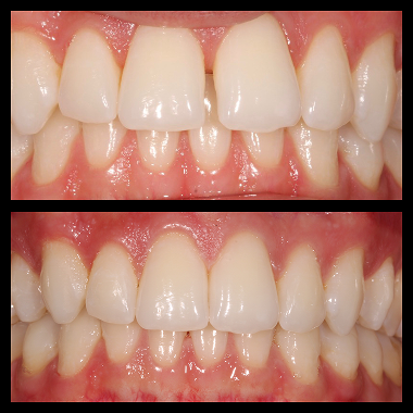 A before / after contrast of teeth straightened out by invisalign