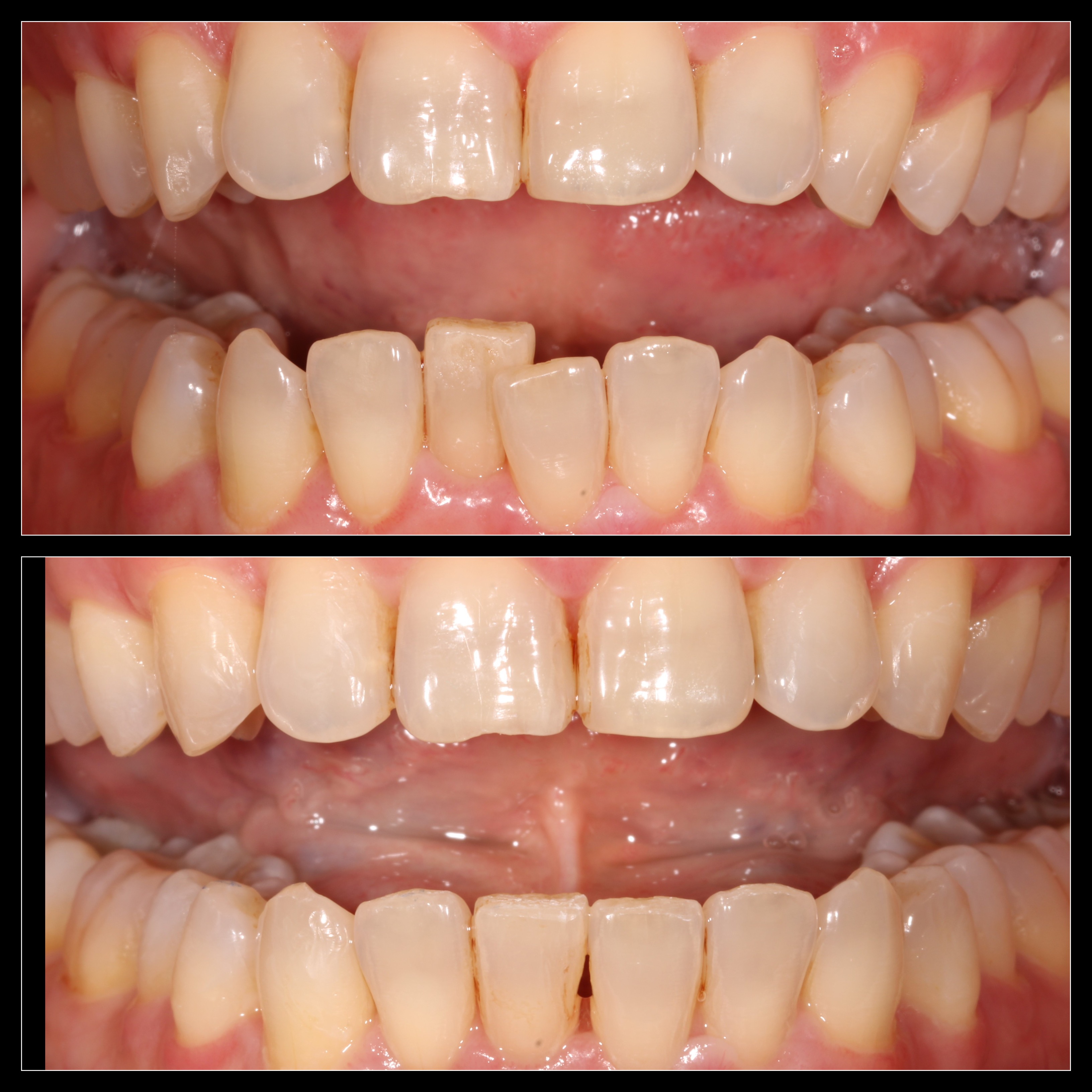A before / after contrast of crooked lower teeth straightened out by invisalign
