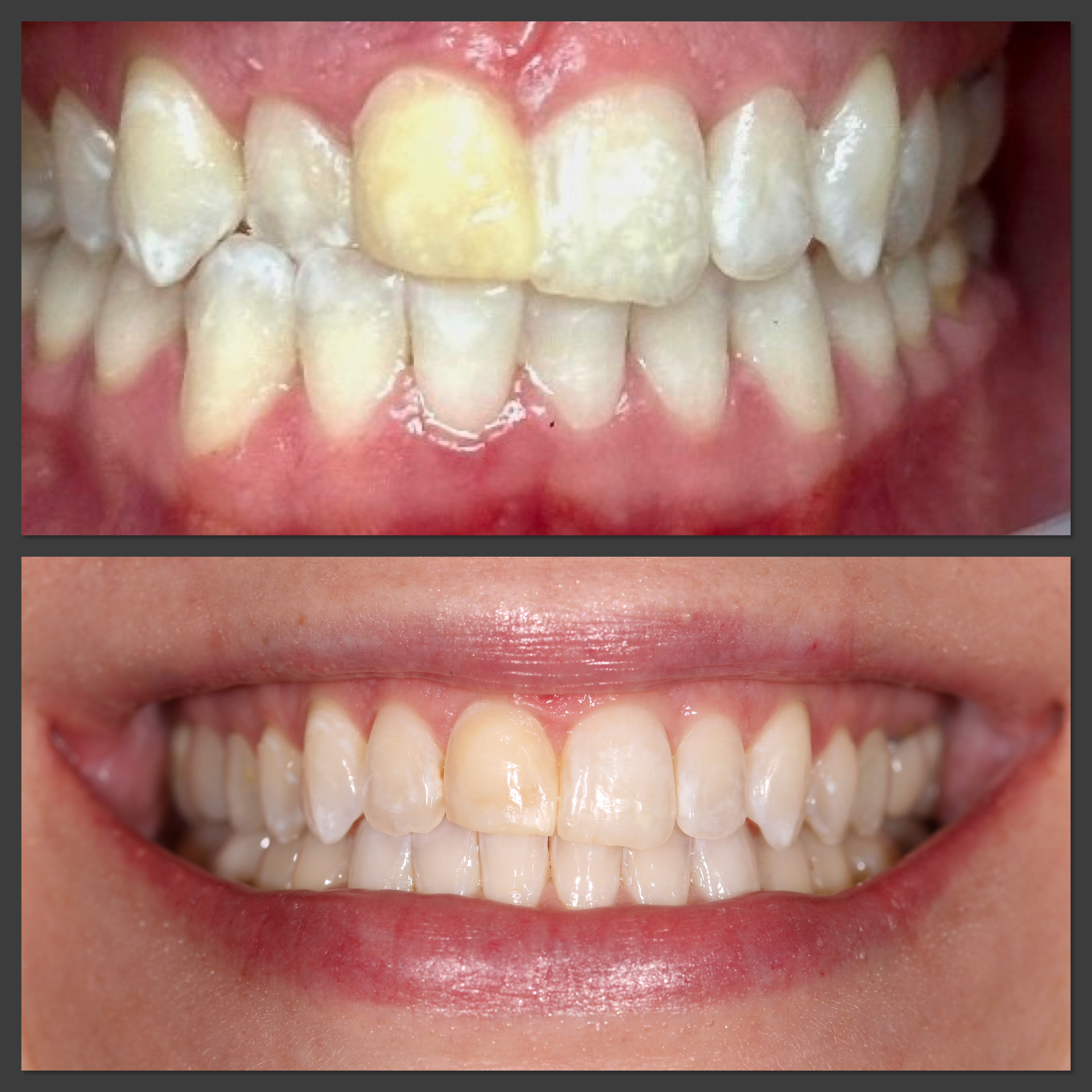 A before / after contrast of teeth straightened out by invisalign, and discoloration fixed
