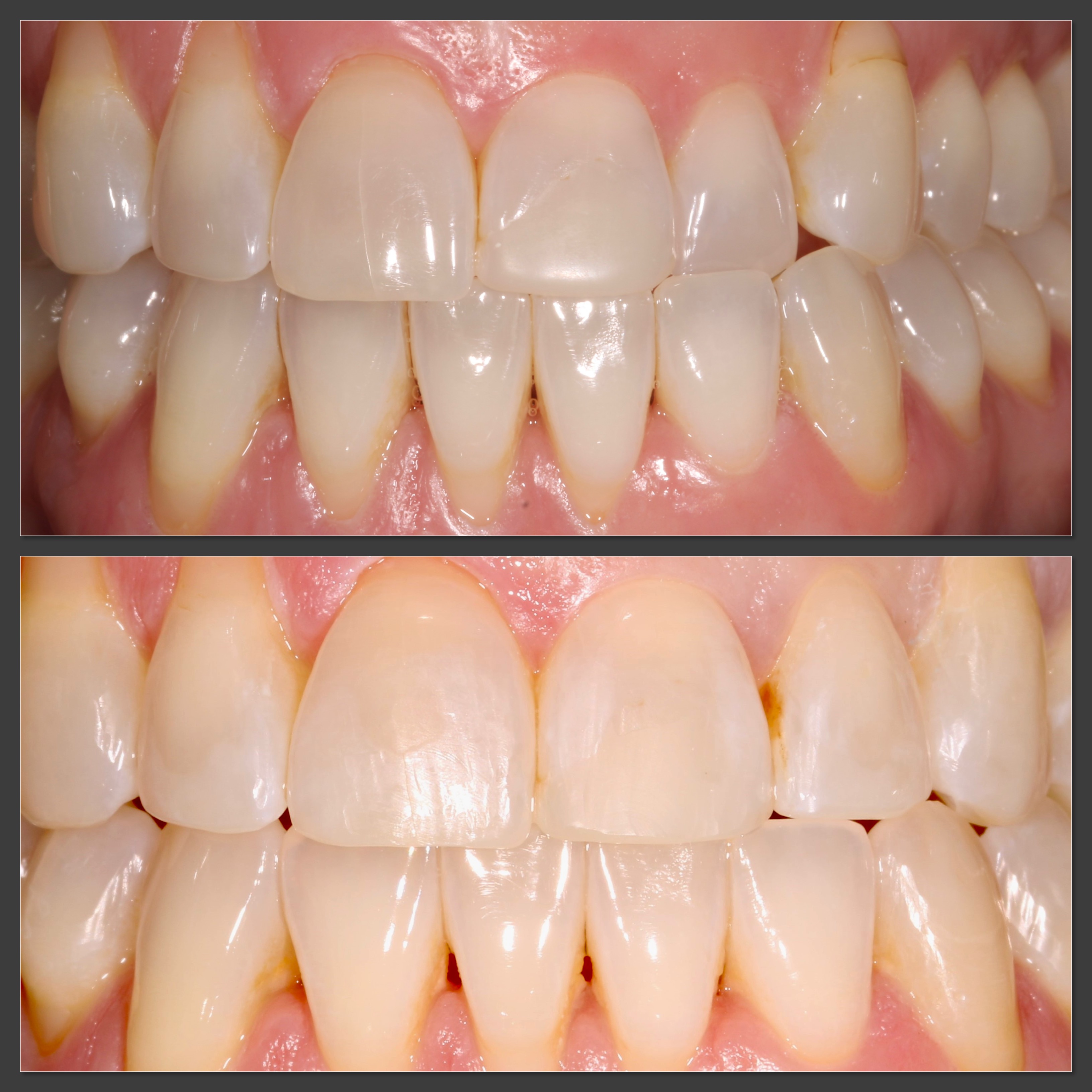 A before / after contrast of top row teeth sitting behind the bottom row, straightened out to sit correctly