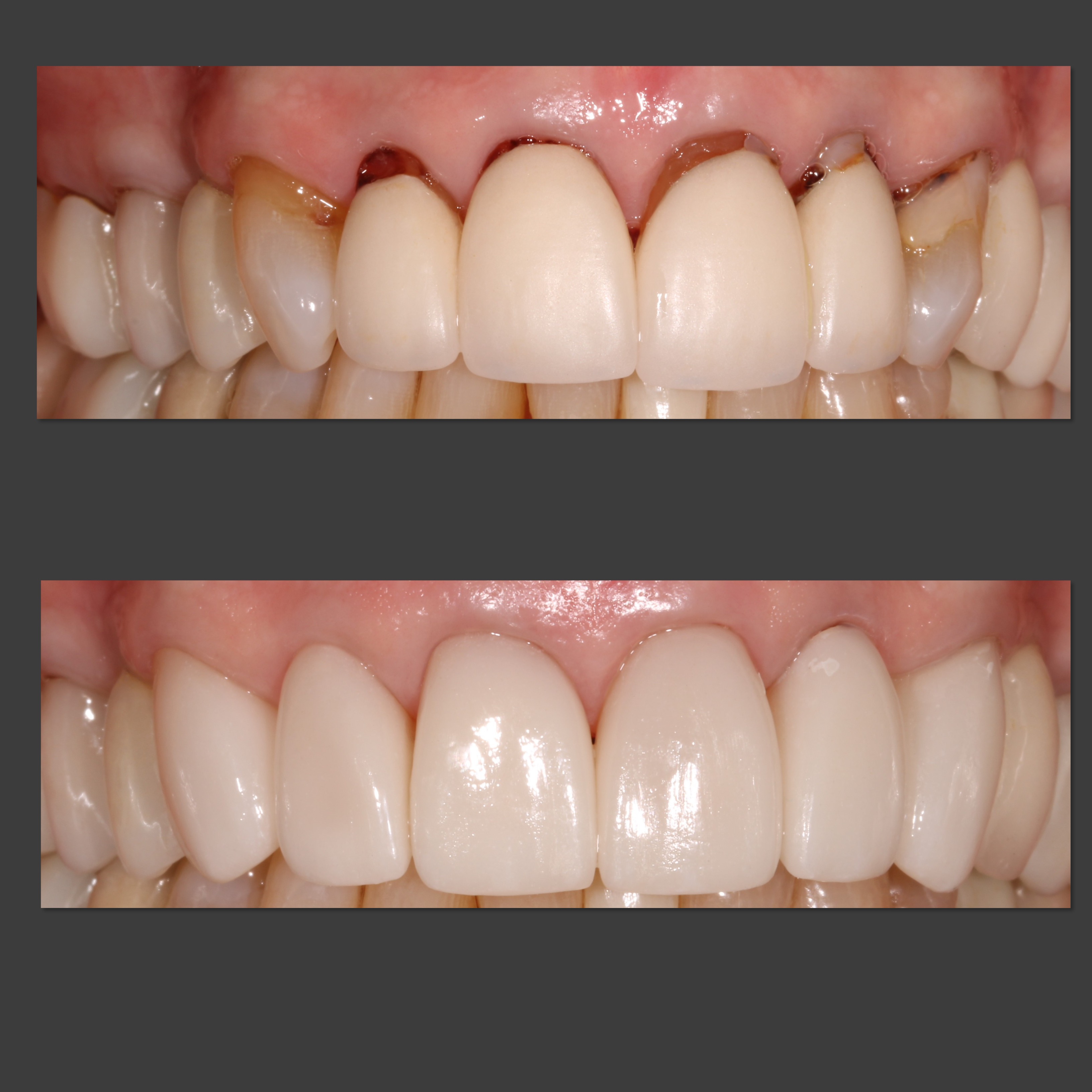 A before / after contrast of teeth straightened out by invisalign