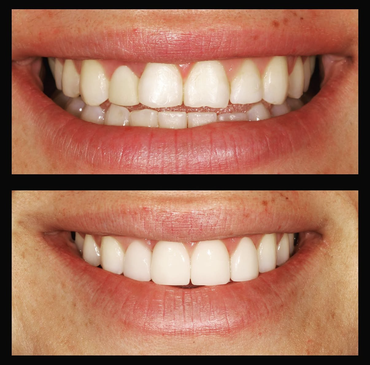 A before / after contrast of teeth straightened out by invisalign