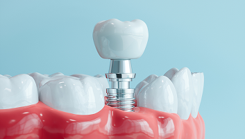 Implant Restorations
