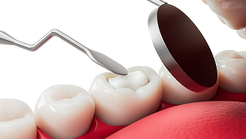 Dental Fillings