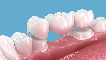 Dental Bridges