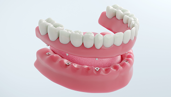 Full and Partial Dentures