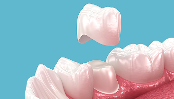 Dental Crowns