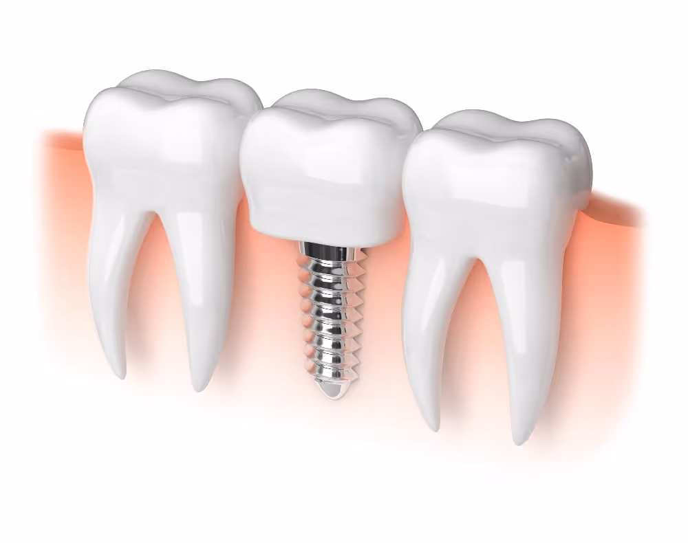 dental implant
