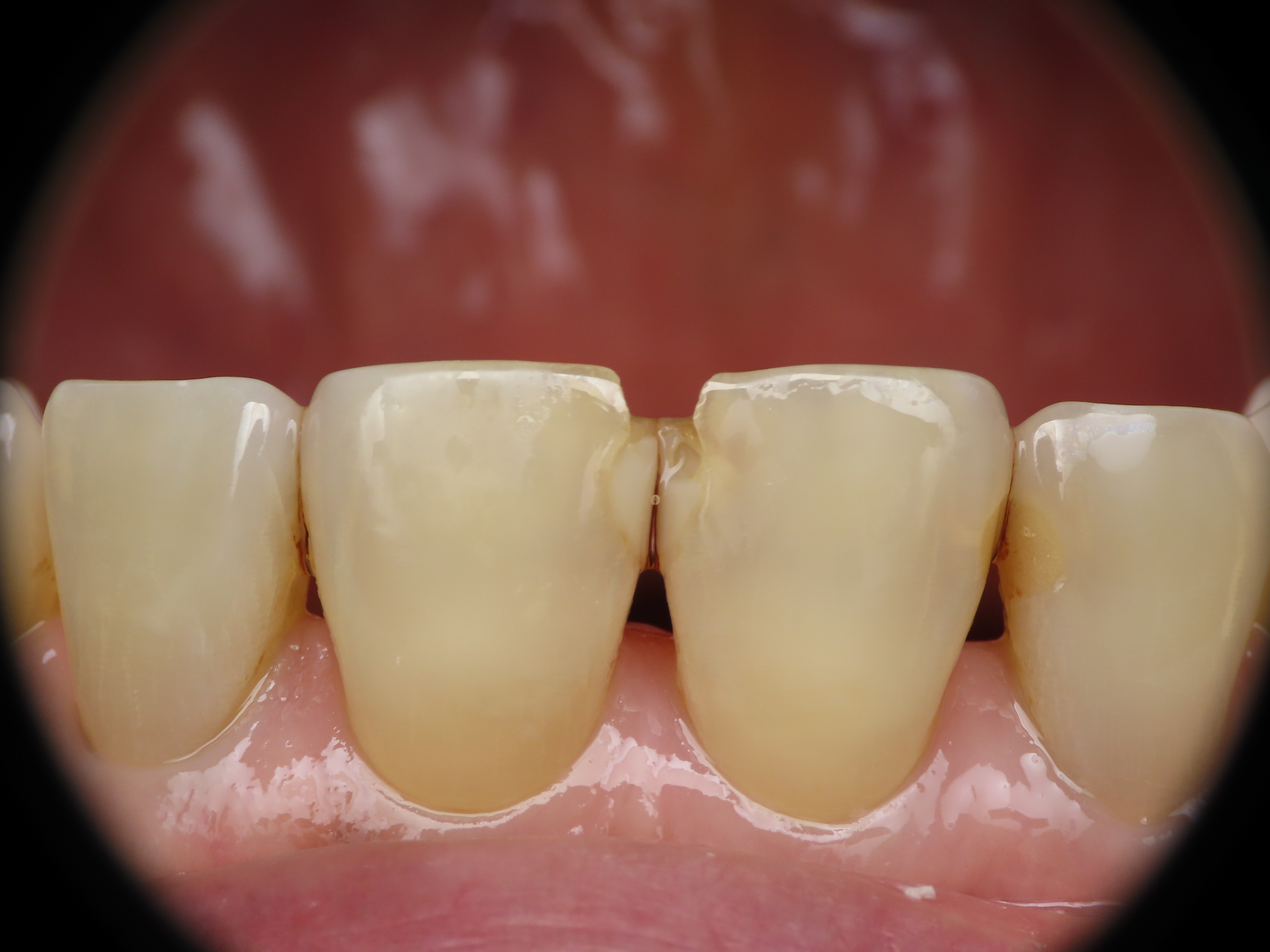 before and after treatment