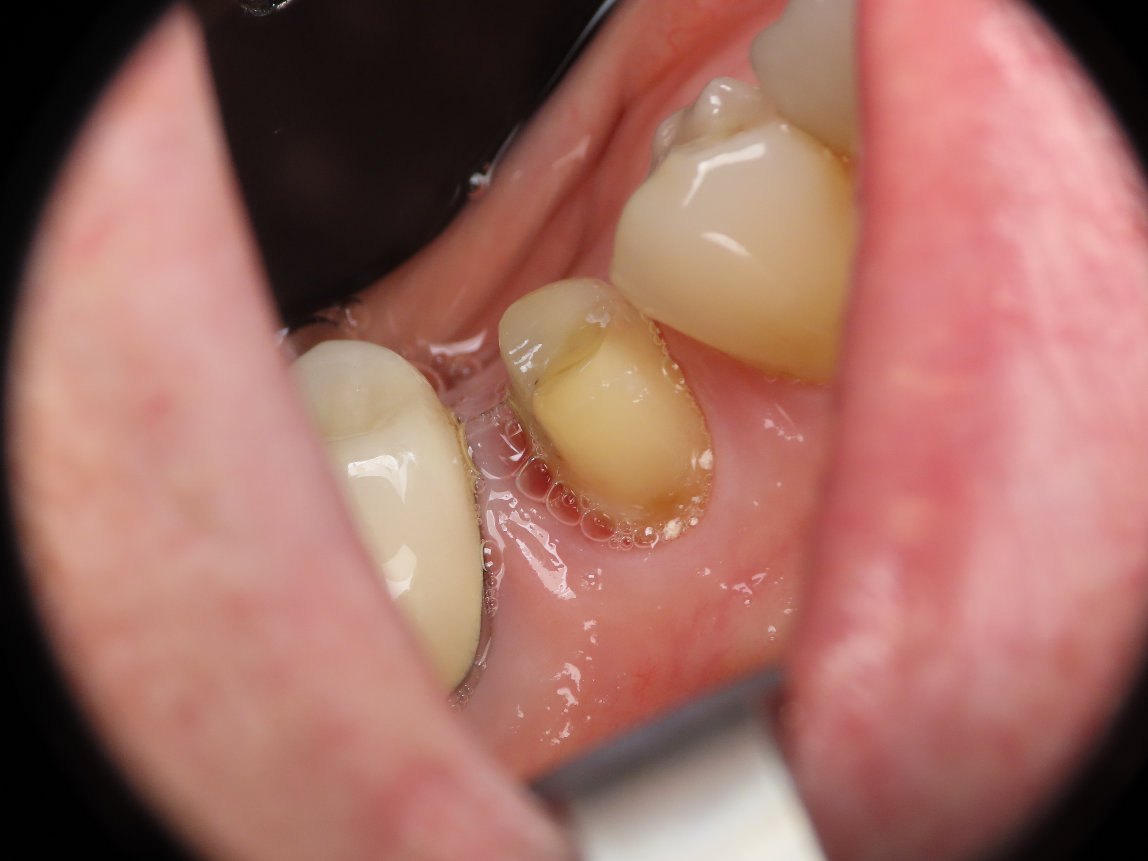 before and after treatment