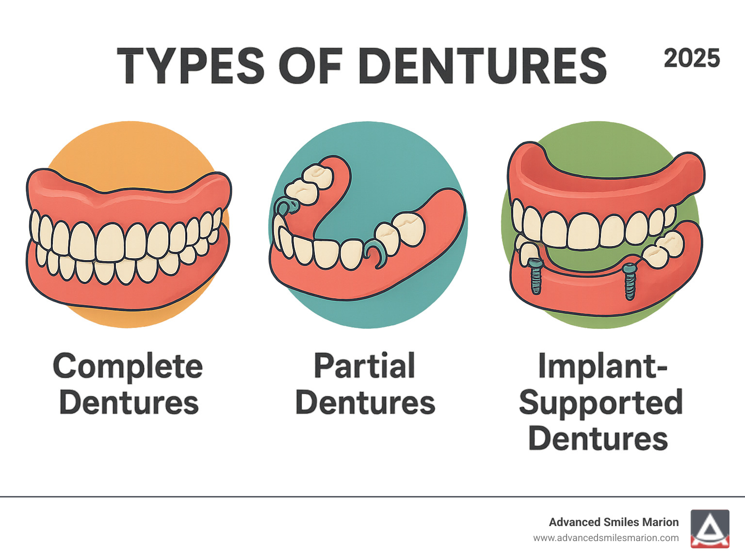 Infographic showing the main types of dentures: complete dentures replacing all teeth with full arch coverage, partial dentures replacing several teeth with metal clasps, and implant-supported dentures with dental implant anchors for increased stability and retention - denture infographic  Infographic showing the main types of dentures: complete dentures replacing all teeth with full arch coverage, partial dentures replacing several teeth with metal clasps, and implant-supported dentures with dental implant anchors for increased stability and retention - denture infographic