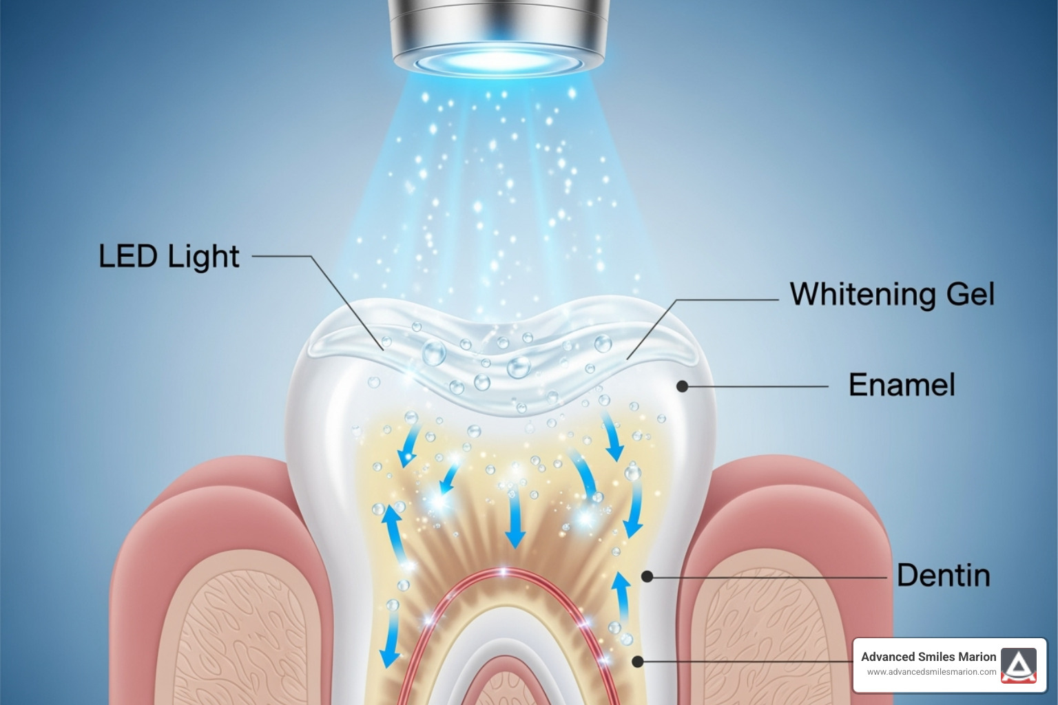 Diagram showing the LED light penetrating the tooth enamel to activate the whitening gel - at home teeth whitening led light Diagram showing the LED light penetrating the tooth enamel to activate the whitening gel - at home teeth whitening led light