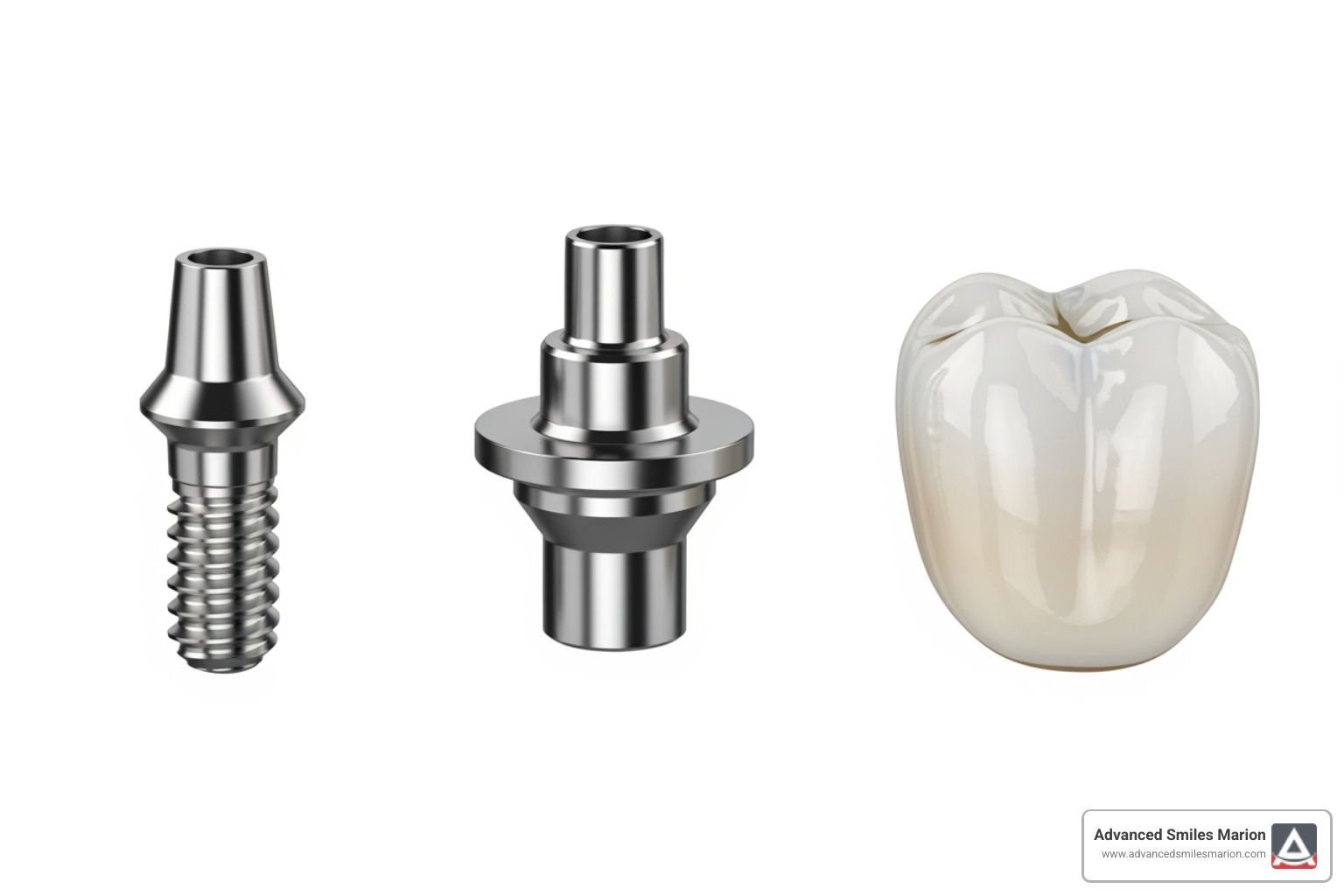 The three separate components of a dental implant: the titanium post, the abutment, and the dental crown - Are dental implants permanent