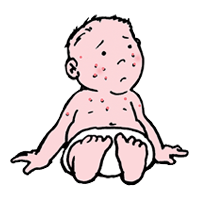 Spots/rash. Do the glass test