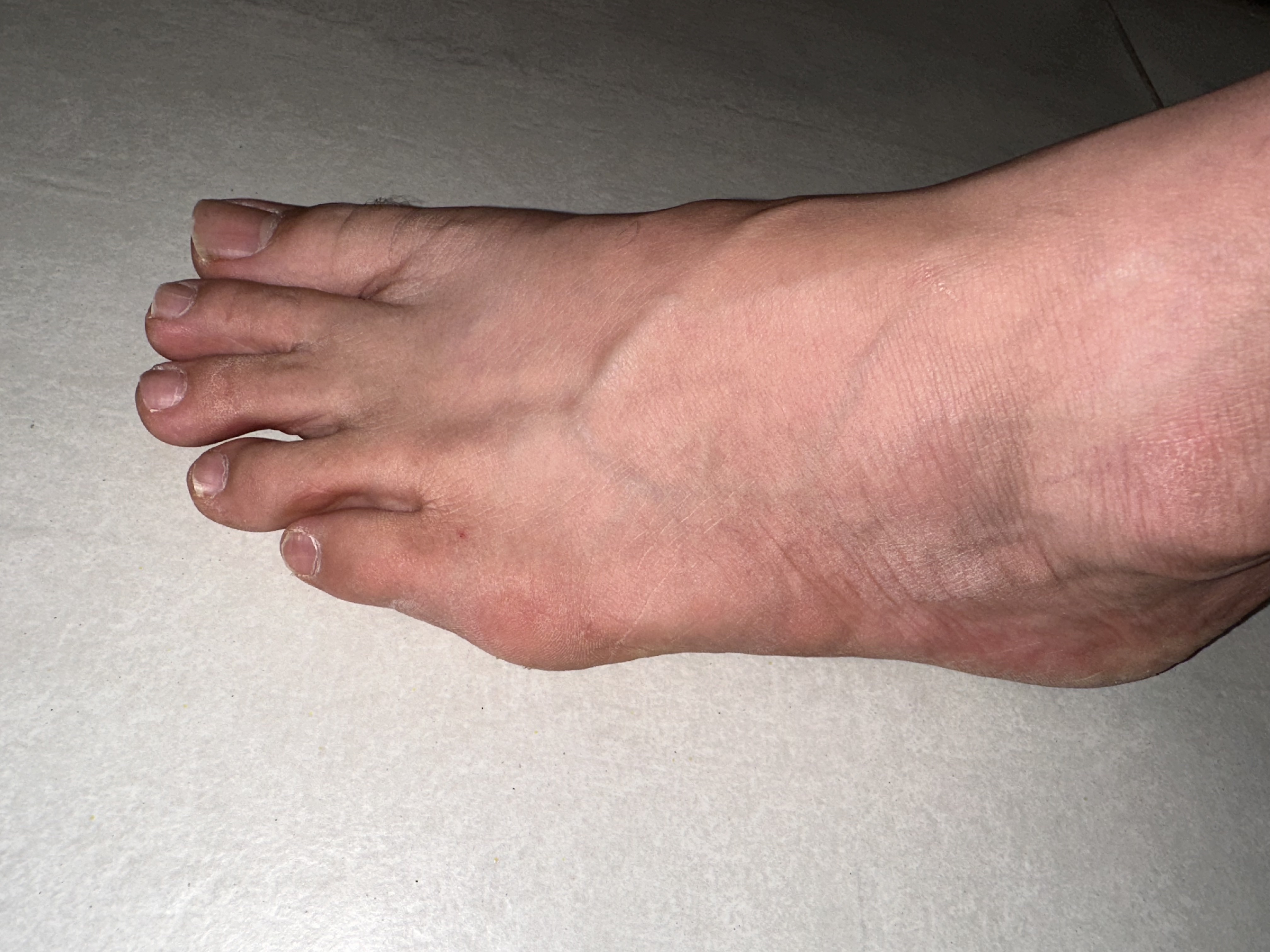 Why Did My Pinky Toe Turn Sideways?