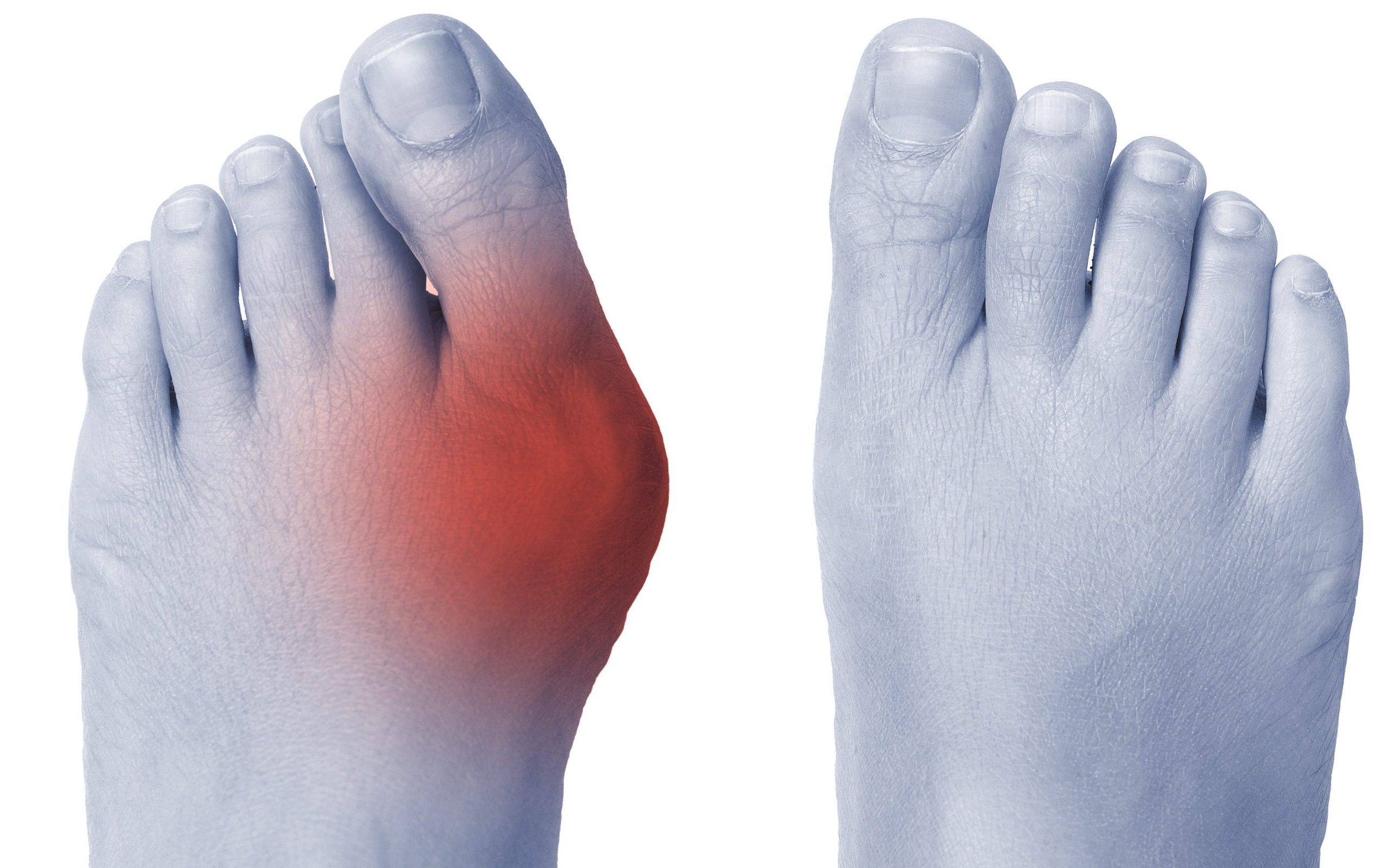Bunions and Other Foot Deformities