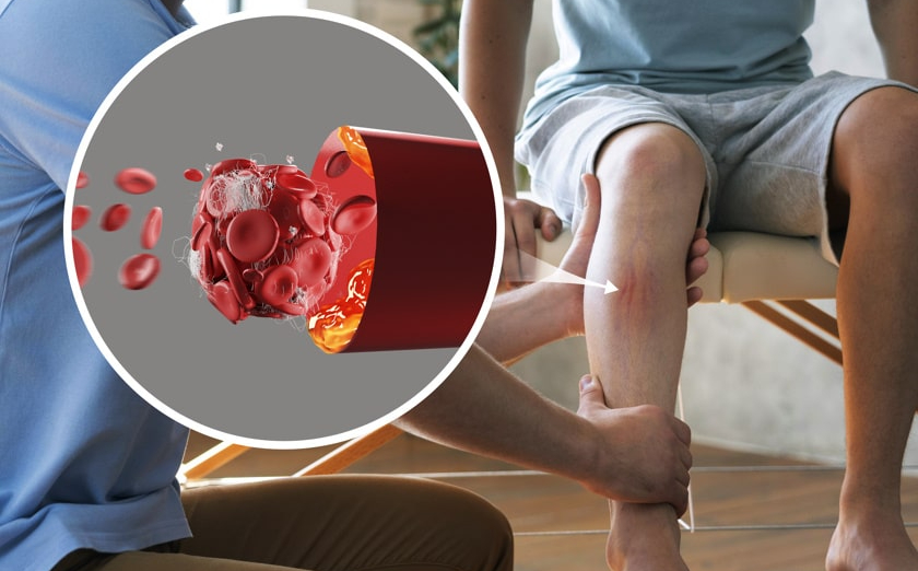 Peripheral Artery Disease