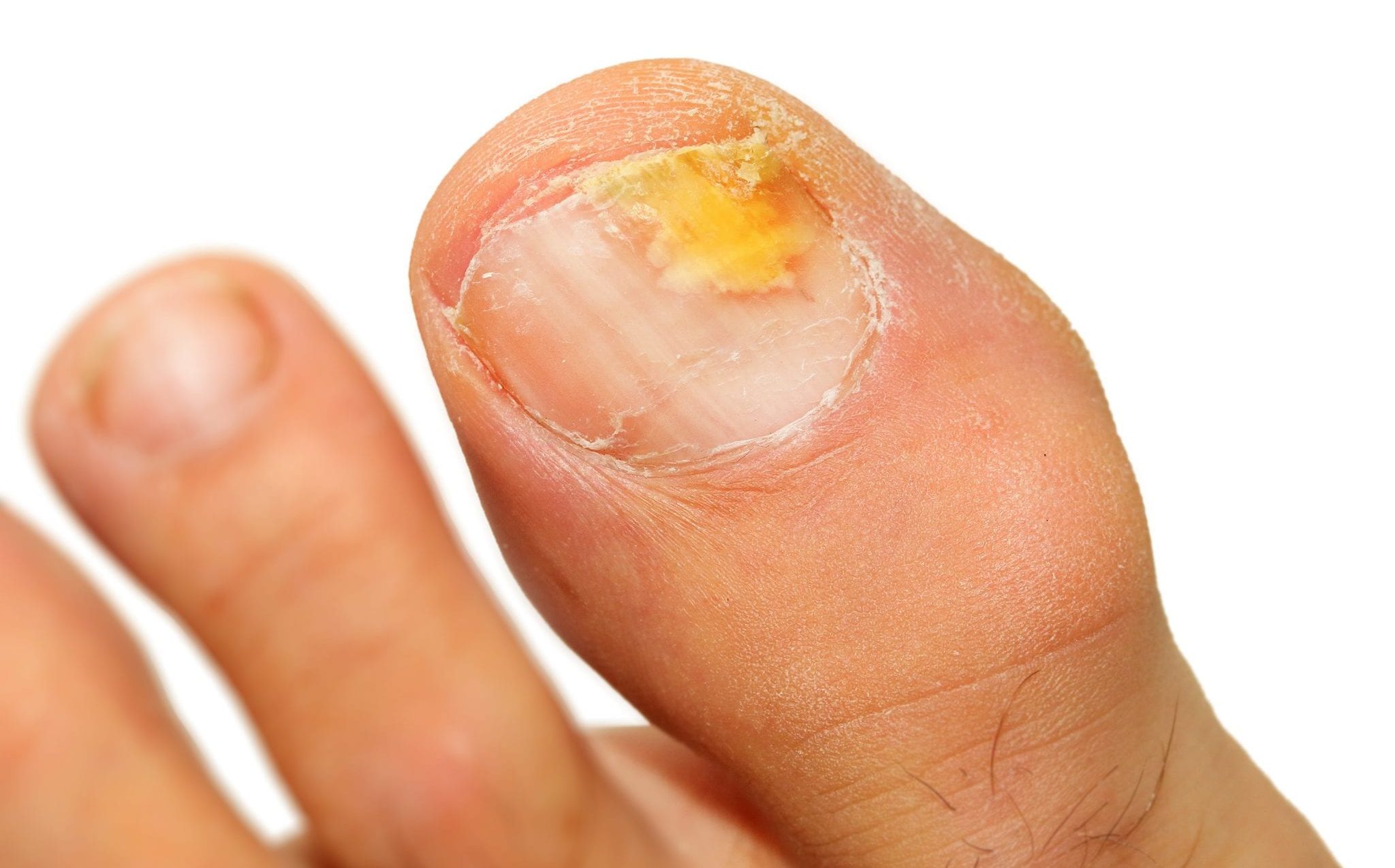 Toenail Fungus