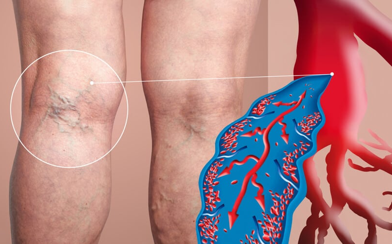 Chronic Venous Insufficiency