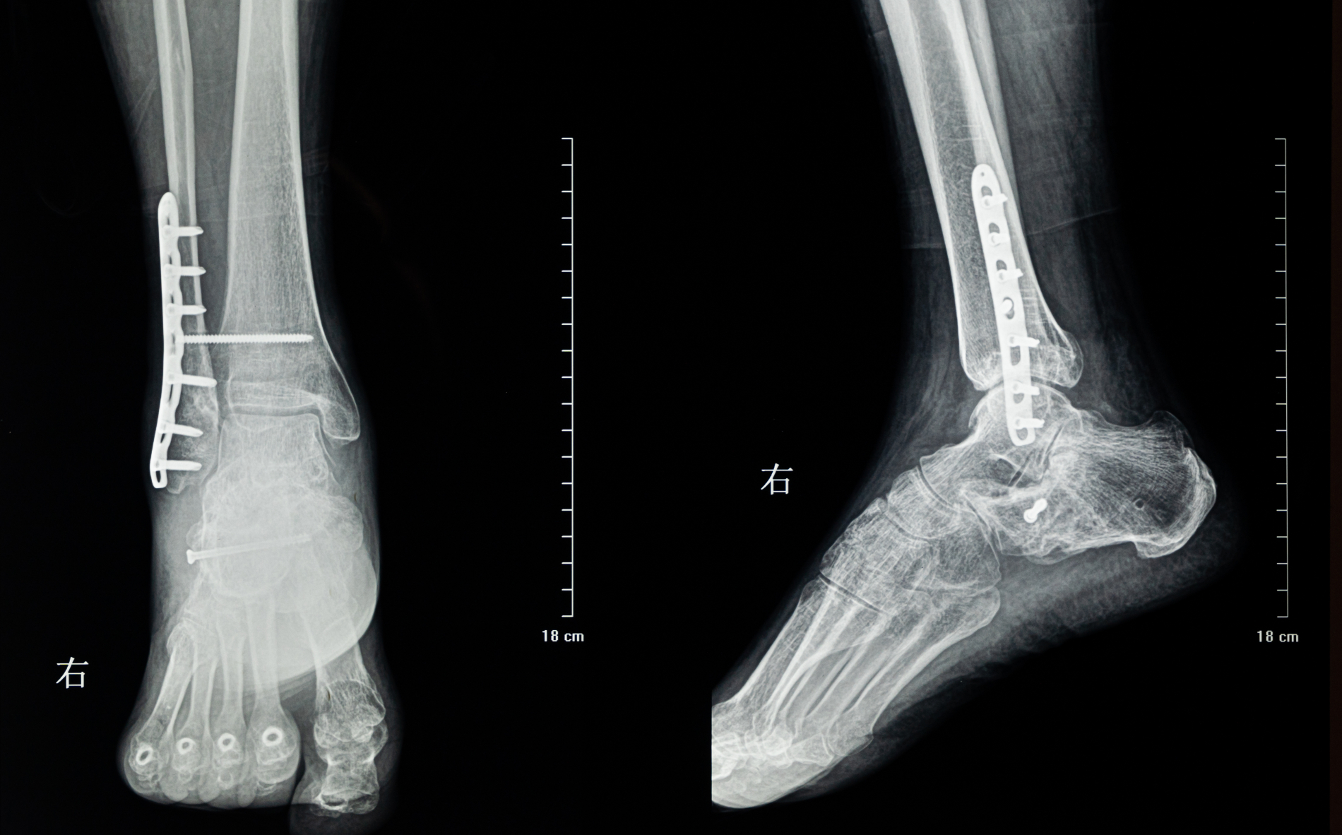 Stress Fractures of the Foot and Ankle