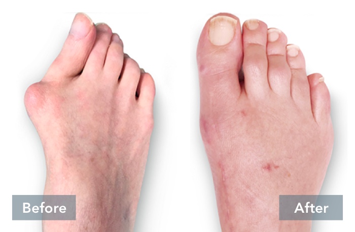 Lapiplasty® 3D Bunion Correction