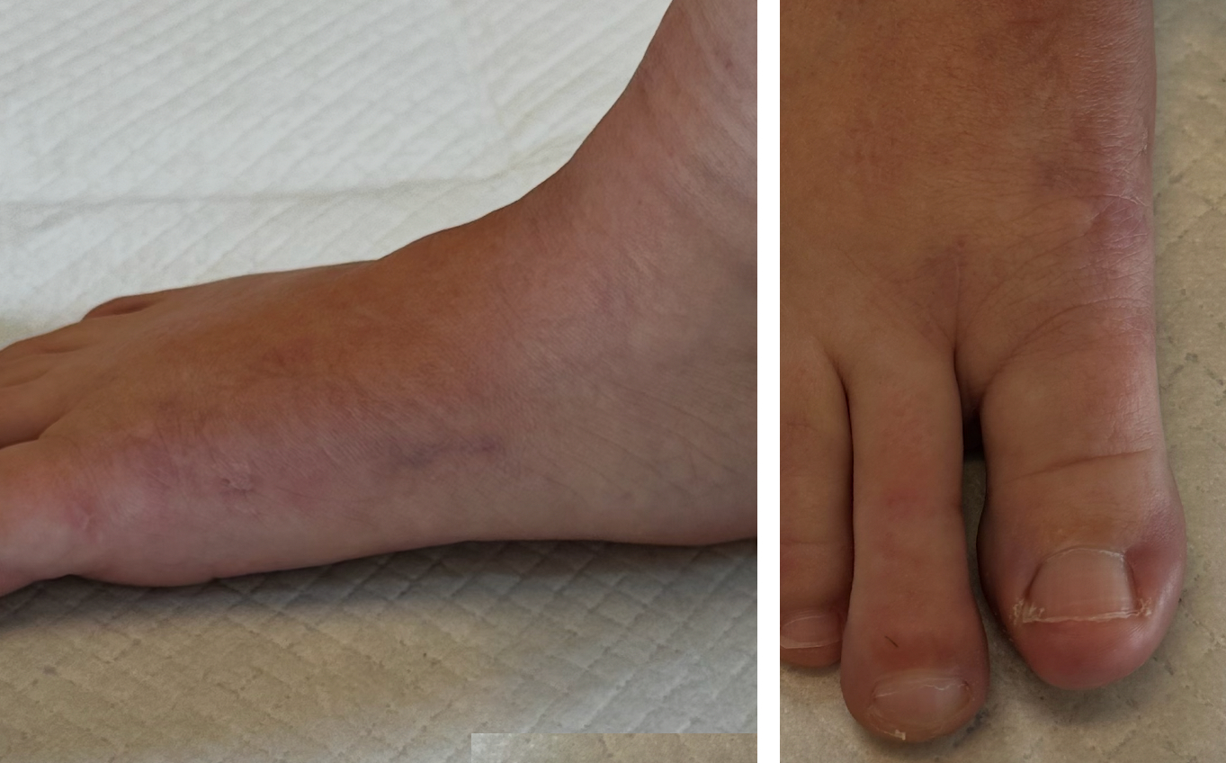 Minimally Invasive Surgery - Foot & Ankle