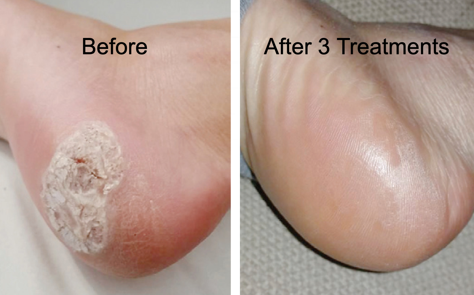 Swift Wart Therapy for Stubborn Plantar Warts