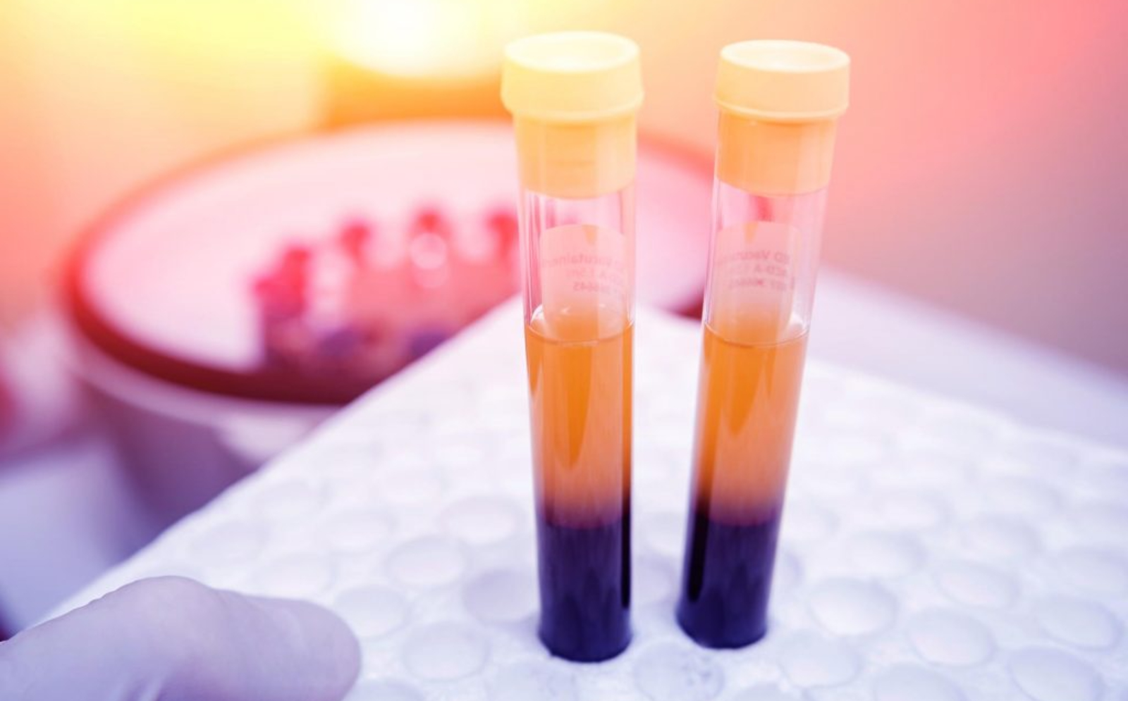 Platelet Rich Plasma (PRP) Treatment