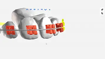 Digital indirect bonding software plotting custom bracket placement on a 3D model of teeth
