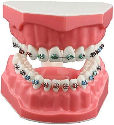 Dental model showing metal braces with colored elastic ties