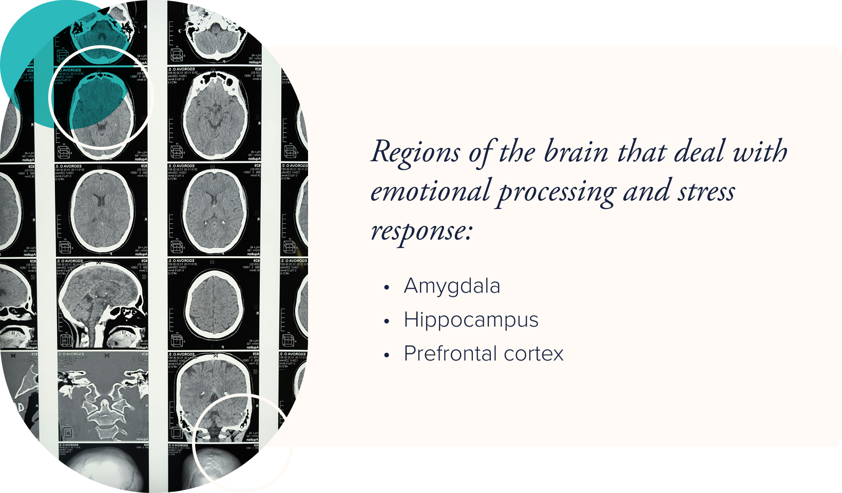 Image: A number of brain scans from different angles. Text: Regions of the brain that deal with emotional processing and stress response - amygdala, hippocampus, prefrontal cortex