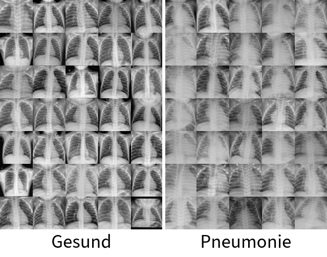 Mit Quanten-KI Pneumonien erkennen