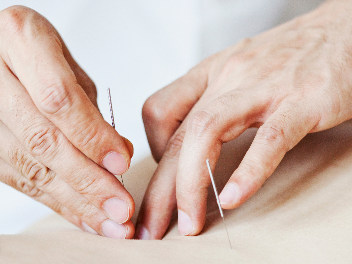 Close-up of hands inserting acupuncture needles into skin.