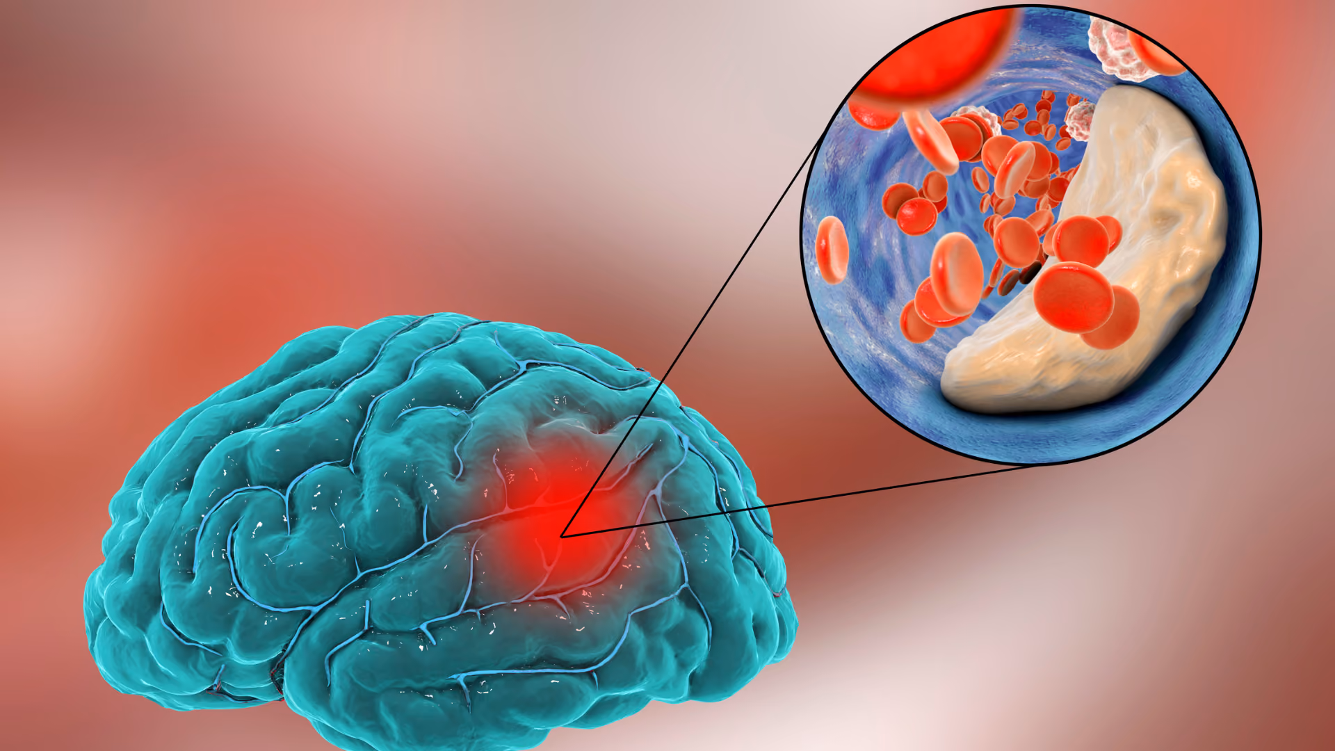 Stroke Treatment & Emergency Care in Dubai 