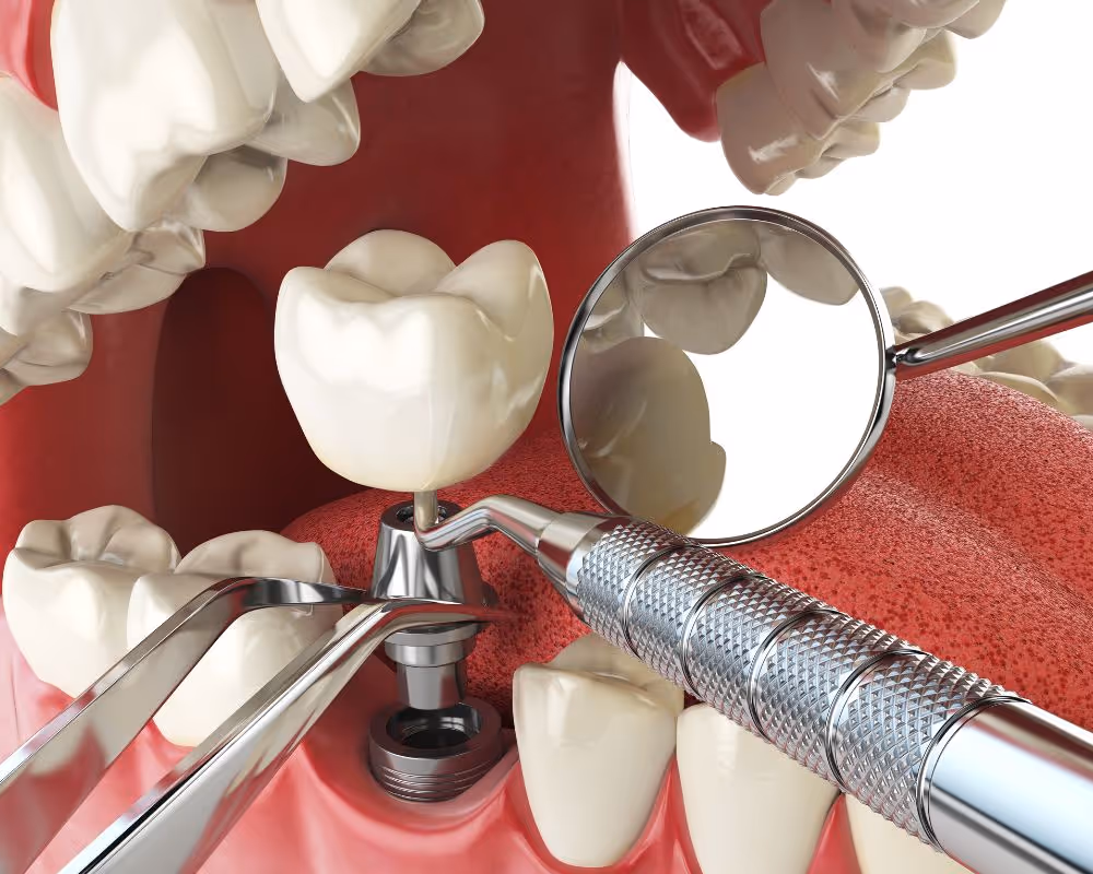 we offer dental implants in Dubai as a permanent, natural-looking solution.
